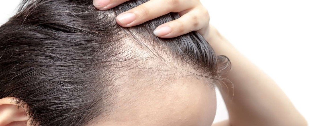 Alopecia androgenetica maschile: come capire se si è affetti