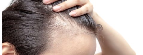 Alopecia androgenetica maschile: come capire se si è affetti