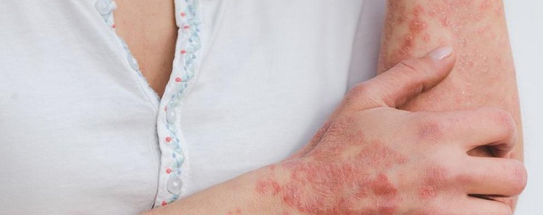 Quali sono i sintomi dell'artrite psoriasica?