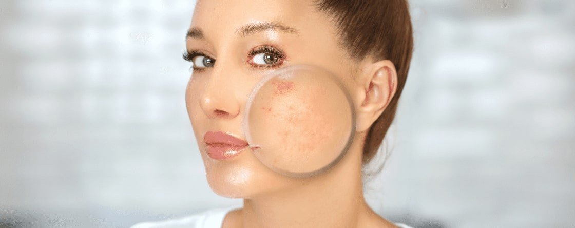Come alleviare i sintomi dell'acne rosacea