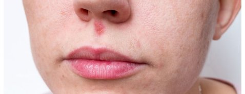 Come riconoscere l'herpes al naso e come curarlo
