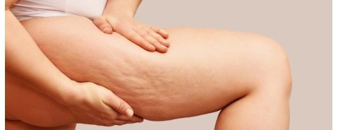 Quali sono i 4 stadi della cellulite?