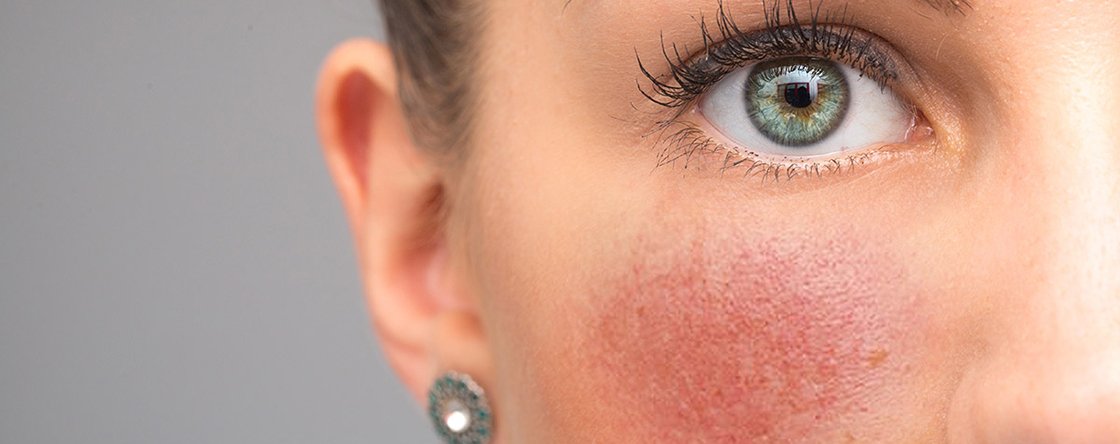 Come curare la dermatite seborroica del viso?