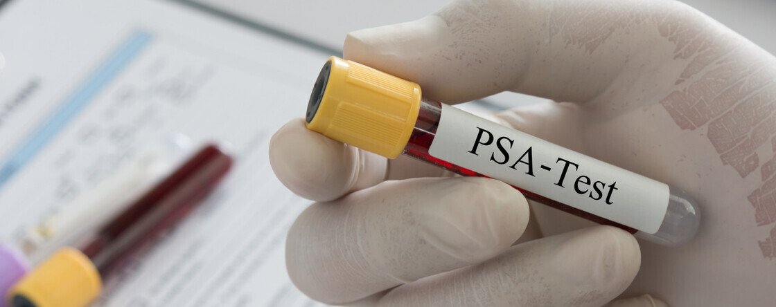 Valori PSA: cosa è, come si calcola, quando preoccuparsi