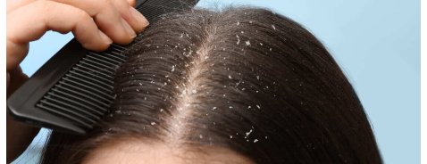 Come capire se è forfora o dermatite? Come capire se è forfora o dermatite?