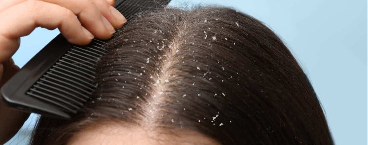 Come capire se è forfora o dermatite?