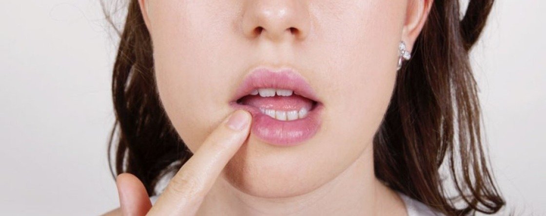 Come eliminare herpes labiale: i rimedi naturali