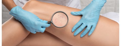 Come curare l'insufficienza venosa agli arti inferiori