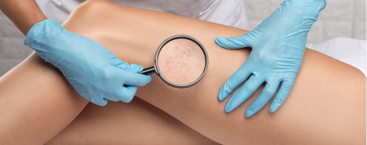 Come curare l'insufficienza venosa agli arti inferiori