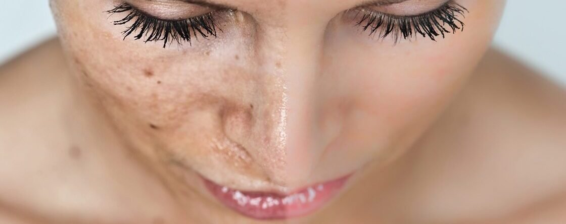 Quali sono i migliori sieri per eliminare le macchie dal viso?