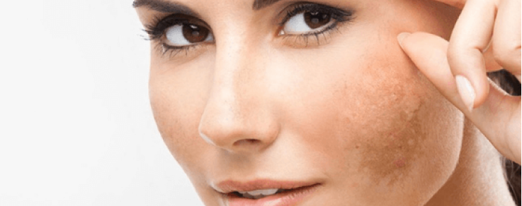 Come eliminare le macchie da iperpigmentazione?