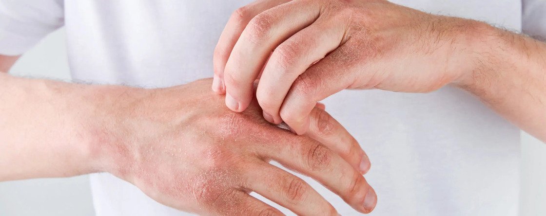 Quali sono le migliori creme per le ragadi alle mani?