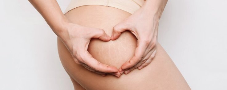 Quali sono le migliori creme per le smagliature rosse?