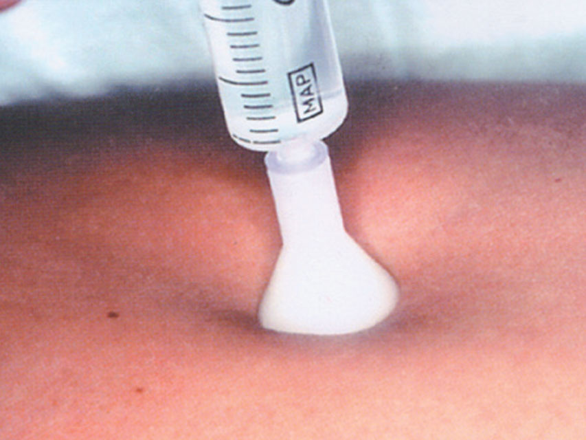 Image of AGO MESOTERAPIA G31 2,5MM 25PZ